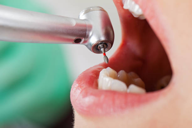 Best Emergency Wisdom Teeth Removal in Shenandoah, TX